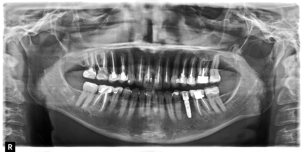 Carillas superiores e implante Clínica Dental Dr. Acosta Carillas superiores e implante Clínica Dental Dr. Acosta
