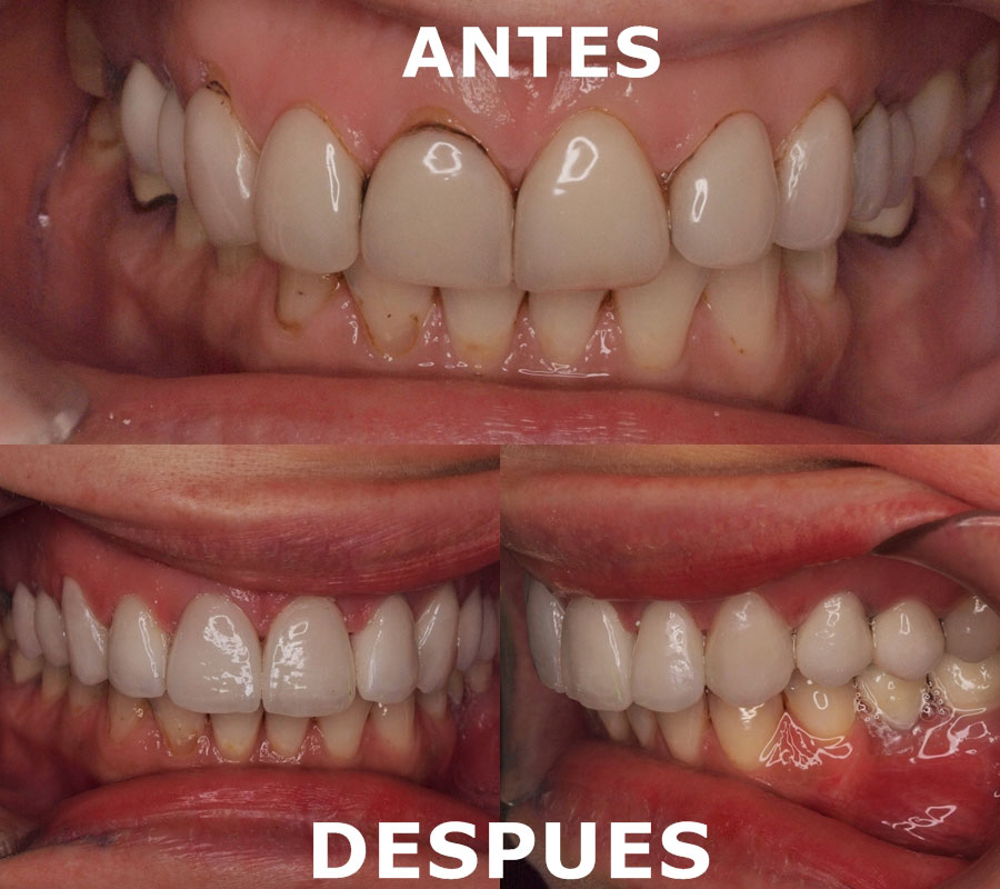 Caso 01 antes y después del tratamiento