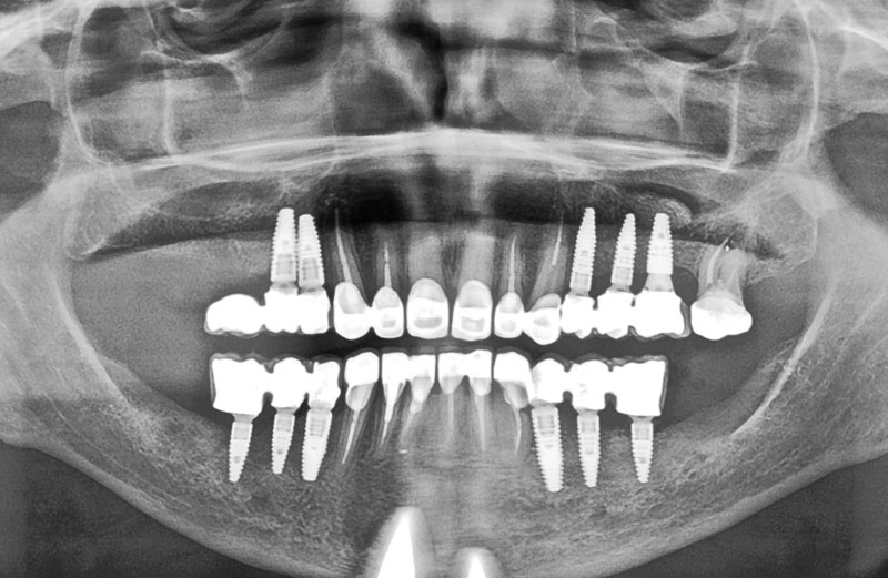 Implantes y corona de Zirconio