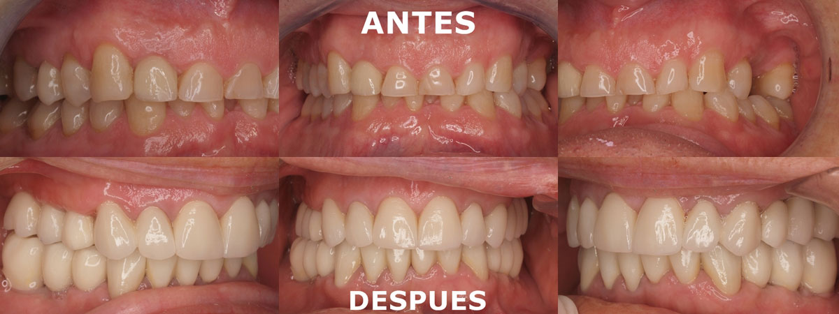 coronas de zirconio antes y despues